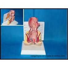 Pathological Model Rectum Anatomical Model